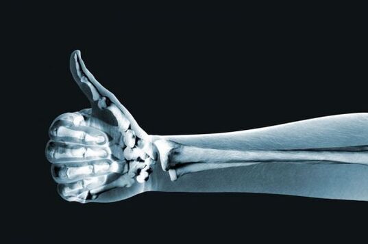 An X-ray can help determine pain in the joints of the fingers